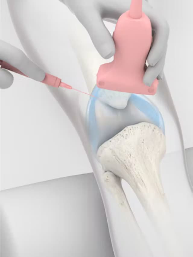 Ultrasound scan and local anaesthetic for the knee