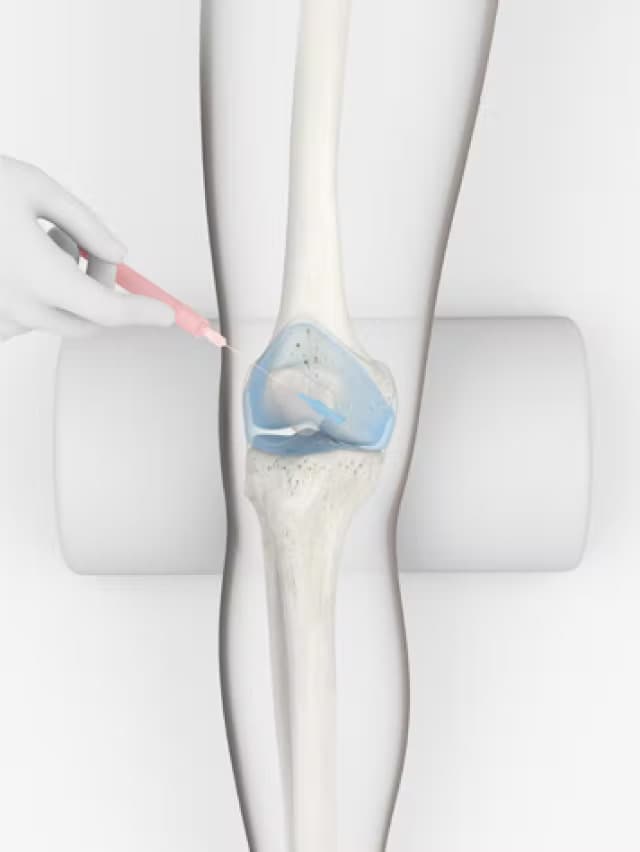 Arthrosamid being injected into the knee joint